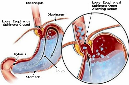 FDA Warns of Increased Bone Fracture Risk With Popular Reflux Drugs